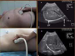 Mở màng phổi tối thiểu dẫn lưu khí - Dịch màng phổi
