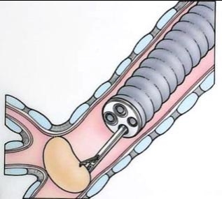 Lấy dị vật phế quản qua ống soi cứng