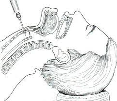 Đặt nội khí quản 2 nòng Carlens